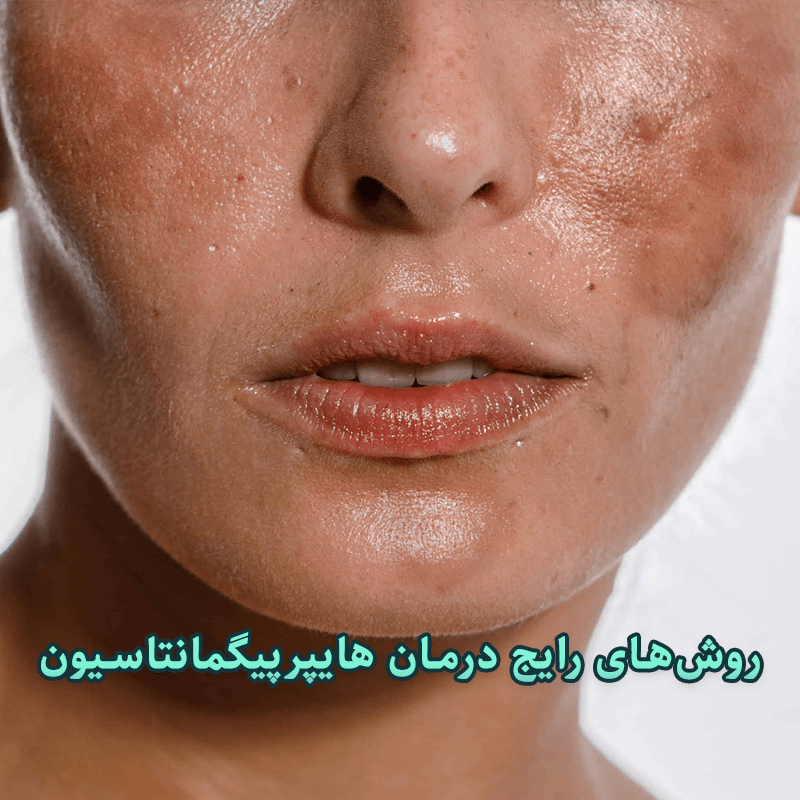 روش‌های رایج درمان هایپرپیگمانتاسیون