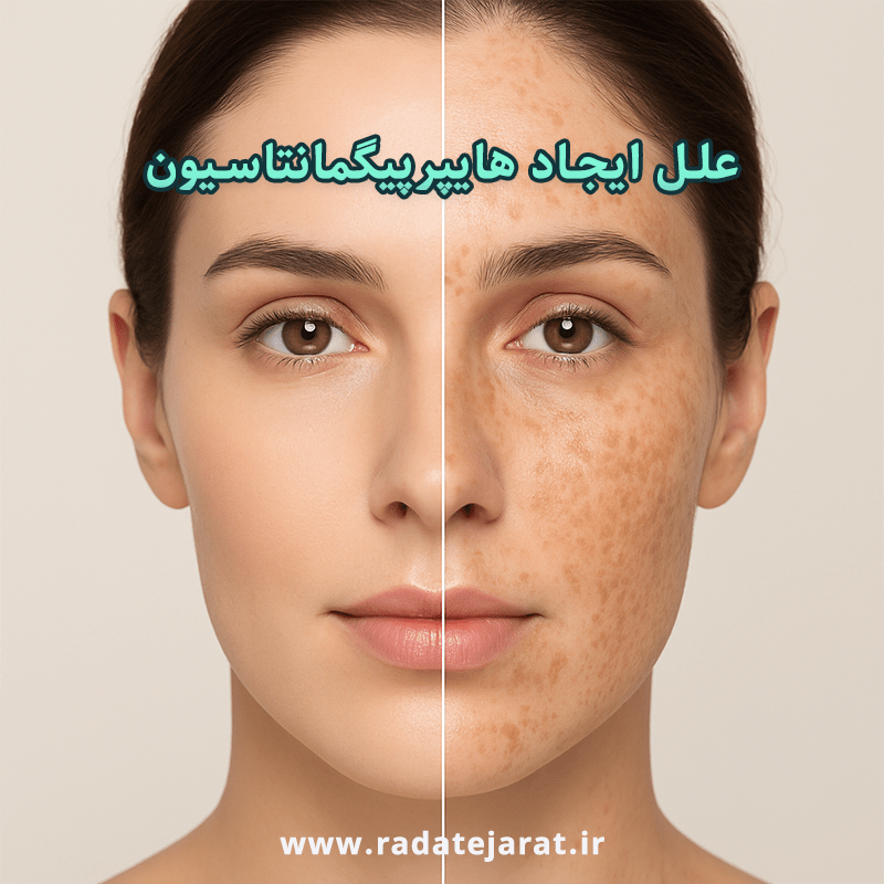 علل ایجاد هایپرپیگمانتاسیون