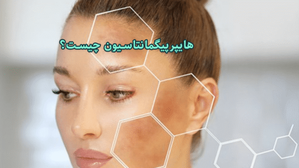 What is hyperpigmentation