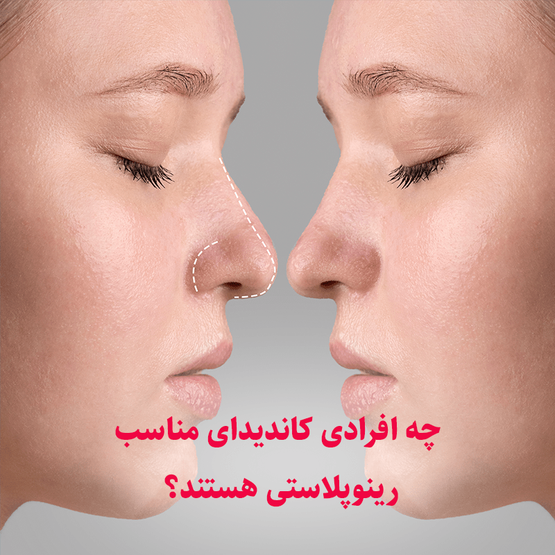 چه افرادی کاندیدای مناسب رینوپلاستی هستند؟